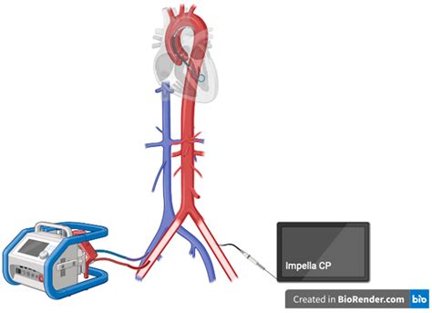 lv venting|va ecmo vs impella.